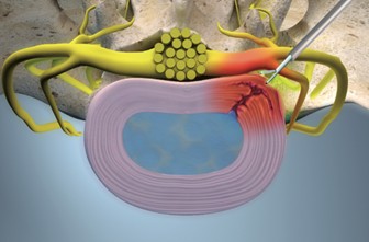 EuroPainClinics Study V - Endoscopic discectomy